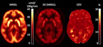 Utility of Absolute Quantification in Non-lesional Extratemporal Lobe Epilepsy Using FDG PET/MR Imaging